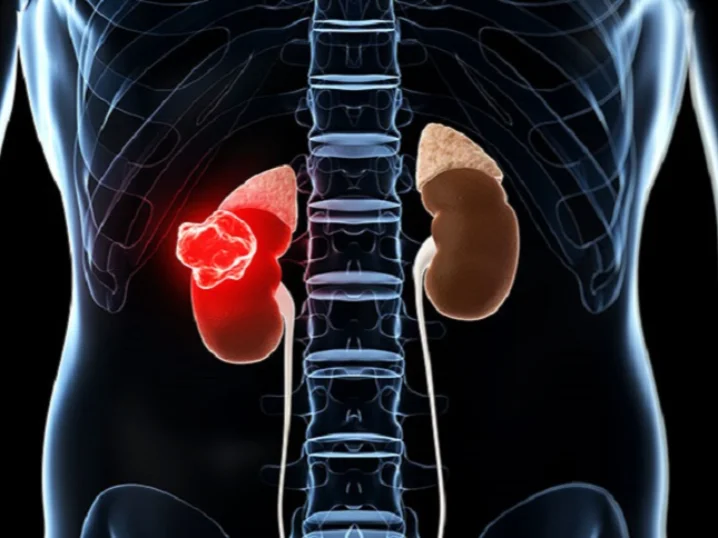 Image de couverture pour What are the first signs of a kidney disease?